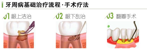 非手术治疗牙周病