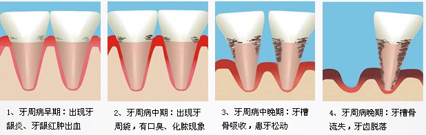 牙周病发展过程