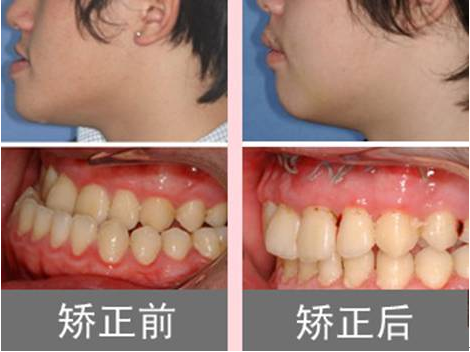 牙齿矫正中心 地包天       (2)德国3d全景机扫描,数据分析,科学精准