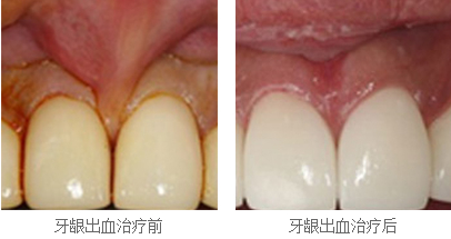 牙龈出血