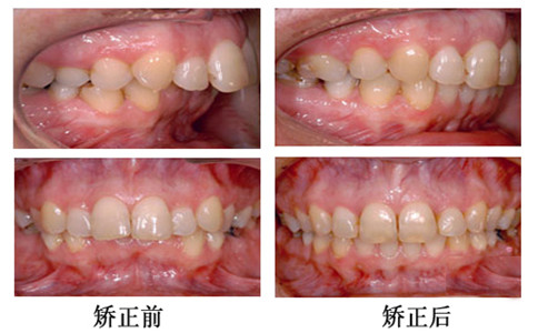 龅牙矫正前后对比图