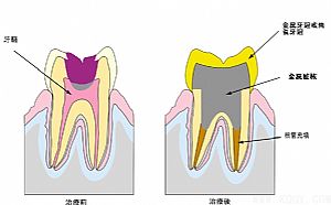 根管治疗效果怎么样？好吗？