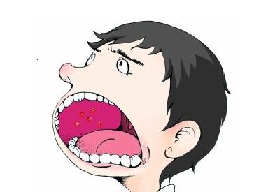 口腔溃疡患者疼痛不已