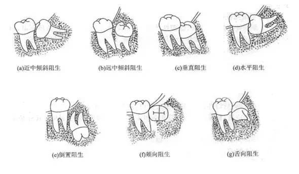 智齿阻生示意图