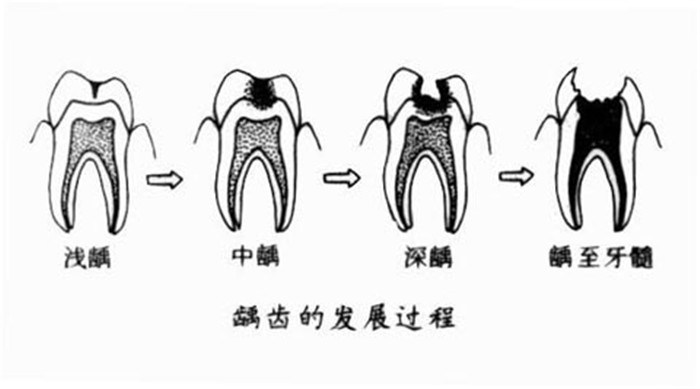 张家港蛀牙的预防方法都有哪些呢