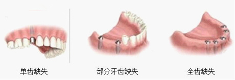 温州后牙缺失哪种修复效果比较好