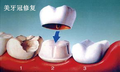 美牙冠修复