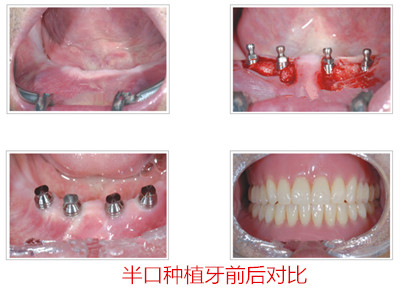 半口牙种植前要做什么准备