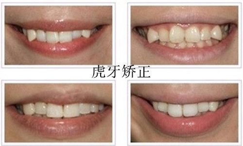 虎牙