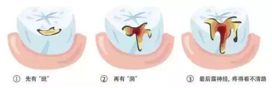 龋齿